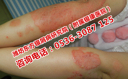 牛皮癣患者哪些食物不能吃
