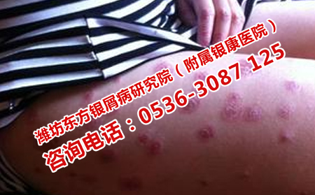 牛皮癣患者常用什么方法护理疾病