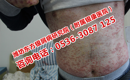 总是反复的牛皮癣治疗