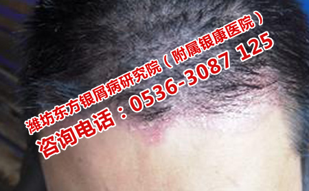 头部牛皮癣应该怎样护理