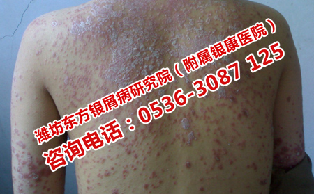 潍坊牛皮癣的方法是什么