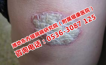 治脓疱型牛皮癣治疗效果理想的医院