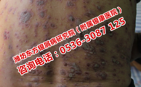 治疗寻常型牛皮癣较有效的方法是什么