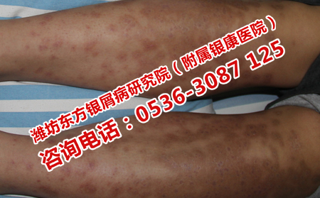 牛皮癣患者在日常应该注意什么
