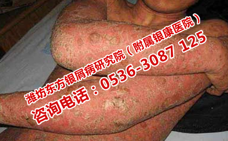 牛皮癣护理不理想有什么严重后果