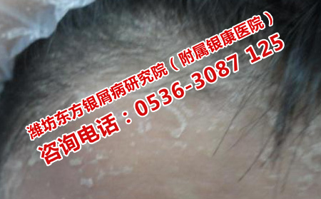 得了牛皮癣应该怎样治疗