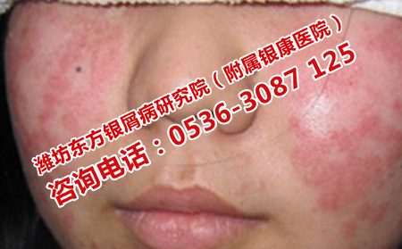 牛皮癣怎么治疗