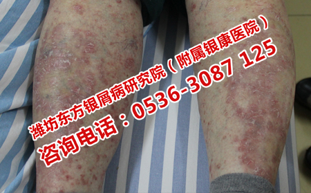 女性治疗牛皮癣的难题