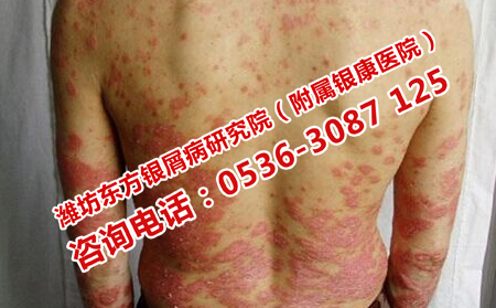 潍坊首先选择的牛皮癣医院