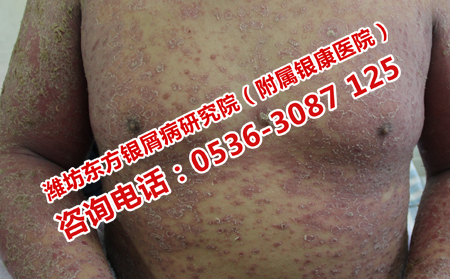 中医治疗银屑病的医院