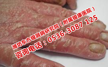 治理想女性牛皮癣