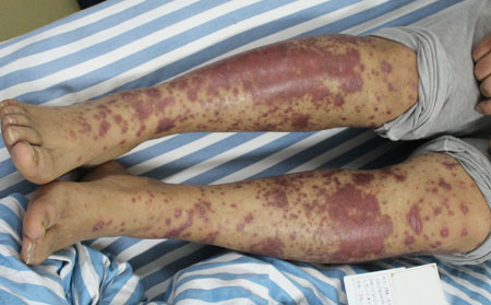 安丘中医治银屑病