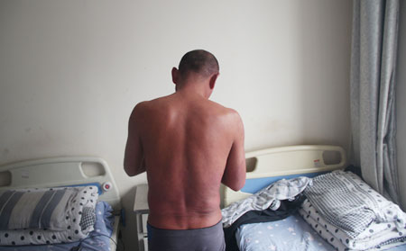 男性牛皮癣治疗效果理想的方法是什么