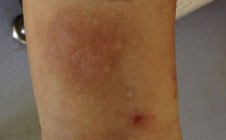 潍坊治疗湿疹的费用