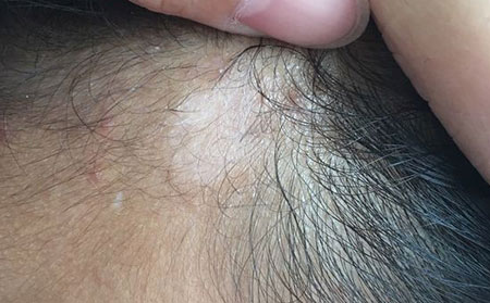 治疗白癜风,稳定型白癜风,白癜风怎样治疗快