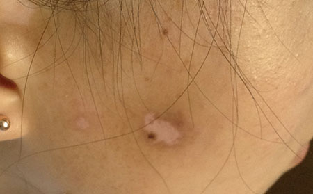 白癜风发病原因,女性白癜风