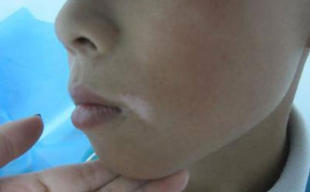冬季白癜风,治疗白癜风比较好
