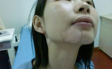 白癜风遗传吗,白癜风会不会遗传给子女