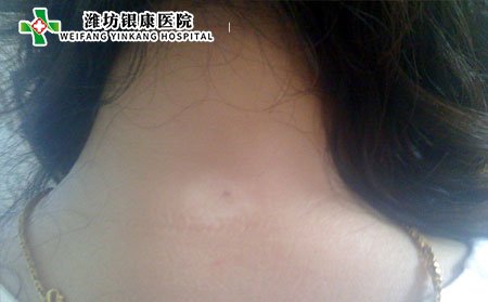 孕妇有白癜风怎么办,孕妇白癜风怎么办