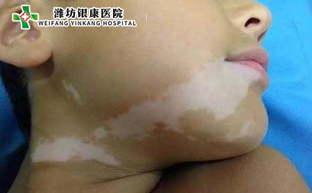 儿童白癜风症状,儿童白癜风什么样