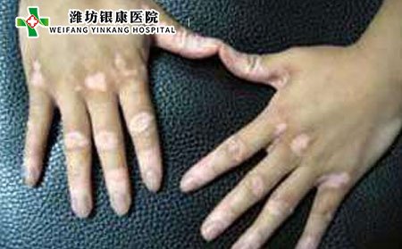 白癜风传染吗,白癜风会不会传染