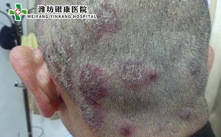 头部银屑病护理,头部银屑病怎样洗