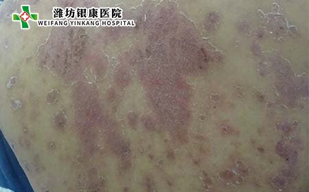 银屑病症状,银屑病有什么表现