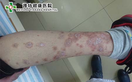 银屑病症状,银屑病什么样