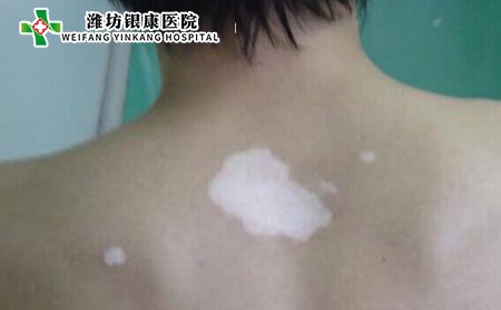 白癜风发病部位,白癜风长在哪个部位