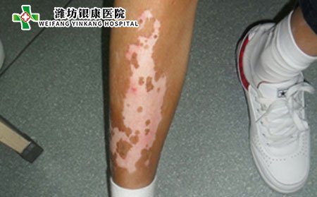 白癜风症状,腿部白癜风症状
