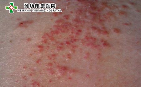 泛发性湿疹,泛发性湿疹传染吗