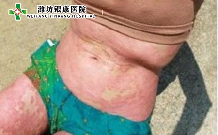 牛皮癣,儿童牛皮癣,牛皮癣症状,儿童牛皮癣症状