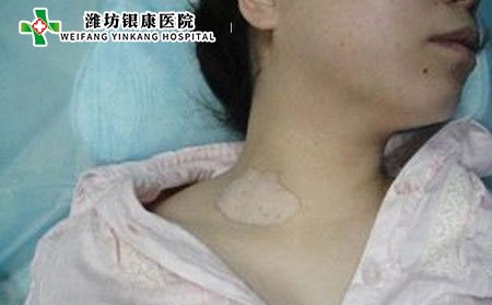 白癜风症状,白癜风症状表现
