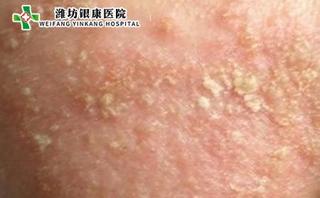 什么是特应性皮炎与湿疹的区别是什么