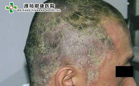 什么是头癣类型有那些?头癣的病因是什么?
