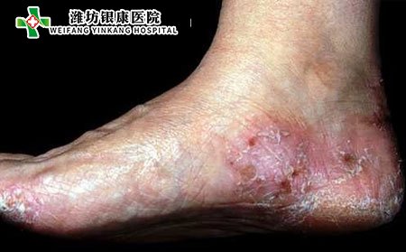 手足癣是什么?水疱型手足癣该如何治疗?