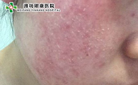 潍坊银康医院:中药防治皮炎