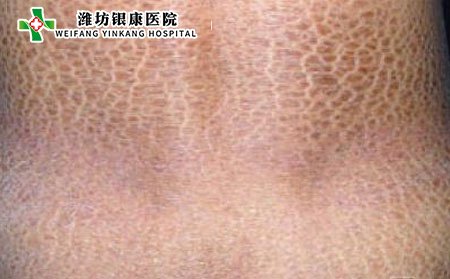 鱼鳞病是什么原因引起的?能治好吗?