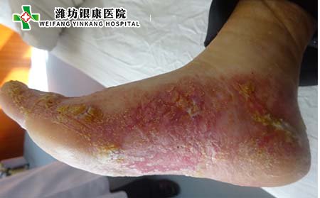 神经性牛皮癣是什么?