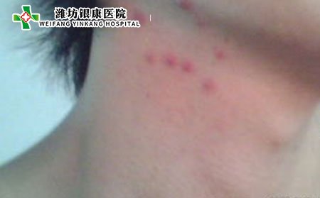 日常生活中该如何预防痤疮?