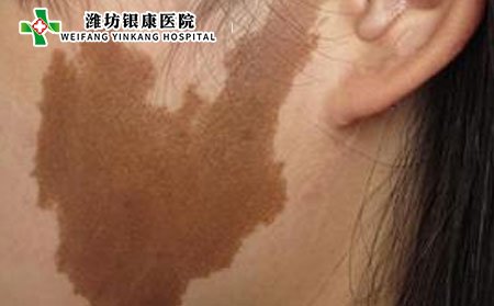 黄褐斑是怎么形成的?电脑族预防黄褐斑图片