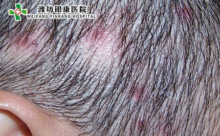 脱发性毛囊炎怎么办?能自愈吗?