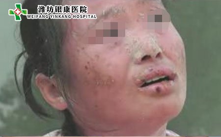 潍坊牛皮癣医院:中药治疗牛皮癣