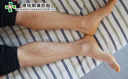 潍坊牛皮癣医院：牛皮癣遗传怎么办?